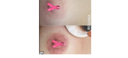 Micropigmentación rusa de Íris